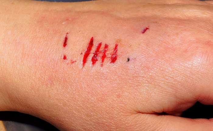 Close-up of bloody scratches on a hand