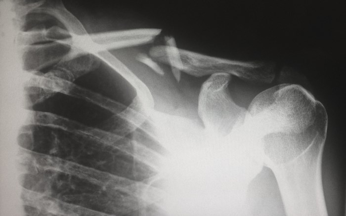 X-ray of a broken clavicle bone
