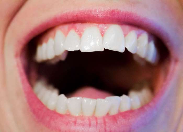 Close-up of a woman's open mouth with white teeth