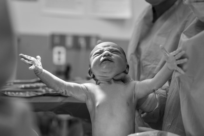 Newborn baby crying during birth in hospital