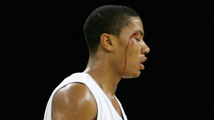 Derrick Rose with bloody face