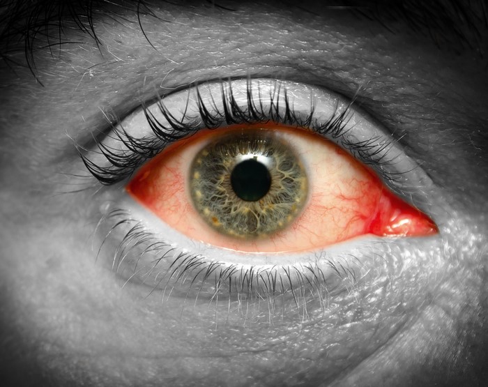 Close-up of a bloodshot human eye